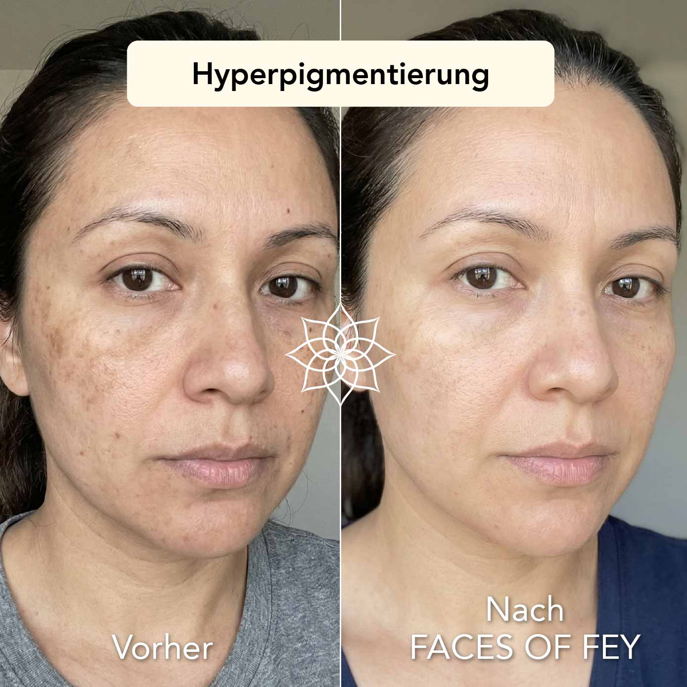 Pigment Control Microneedling System