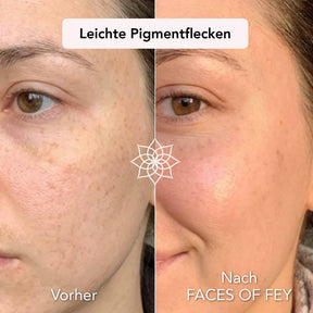 Skin Refining Microneedling System