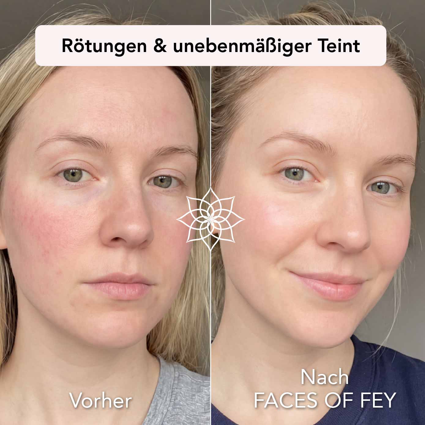 Skin Refining Microneedling System