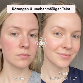 Skin Refining Microneedling System
