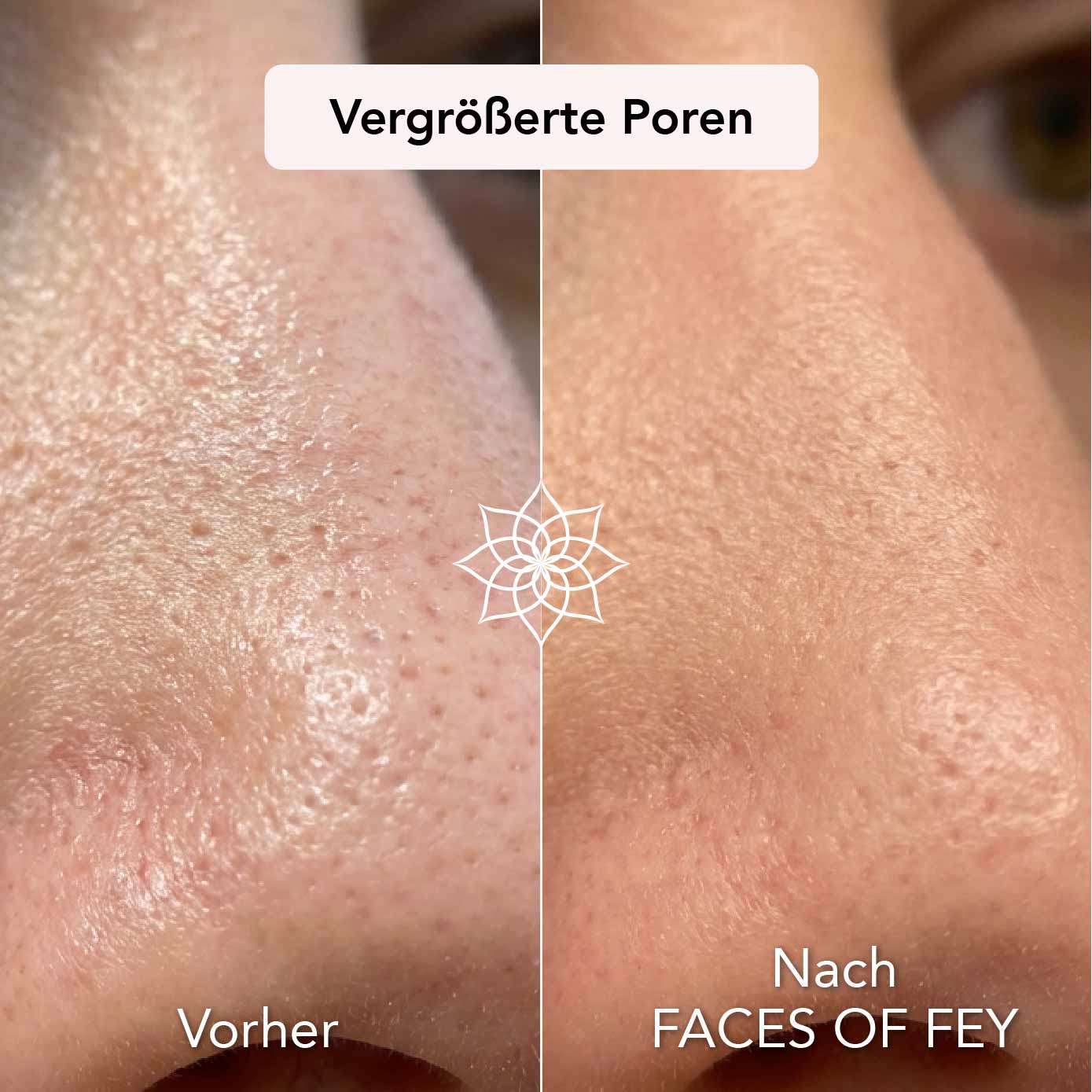 Skin Refining Microneedling System