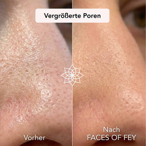 Skin Refining Microneedling System