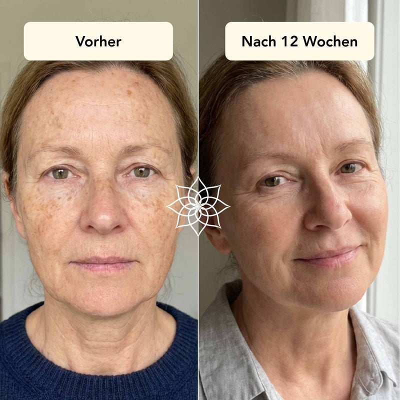 Pigmentflecken & Altersflecken