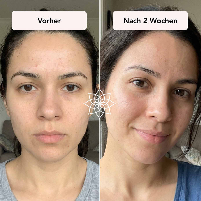 Fahler Teint & leichte Pickelmale