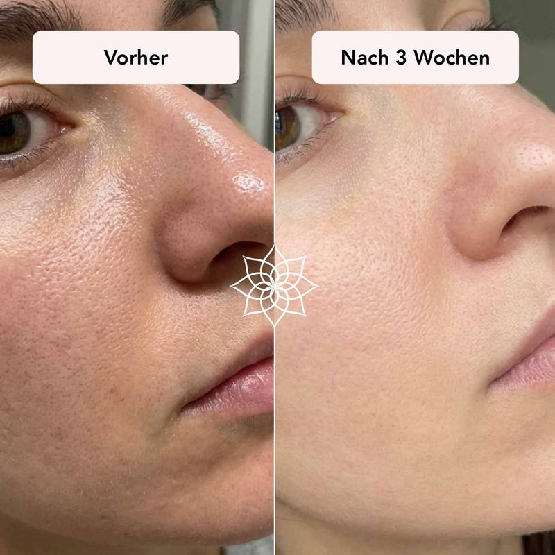 Große Poren im Gesicht