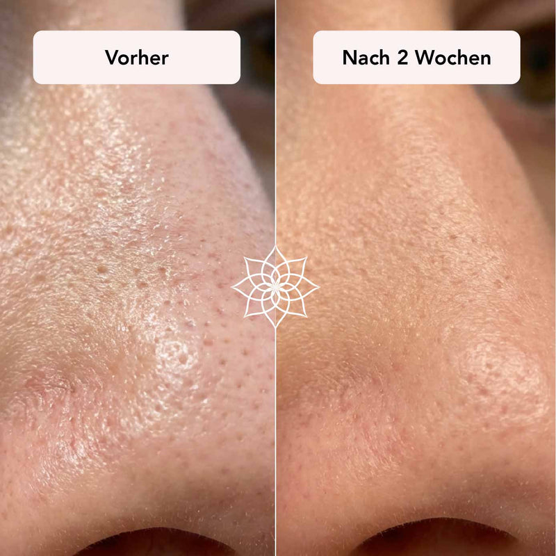 Große Poren an der Nase