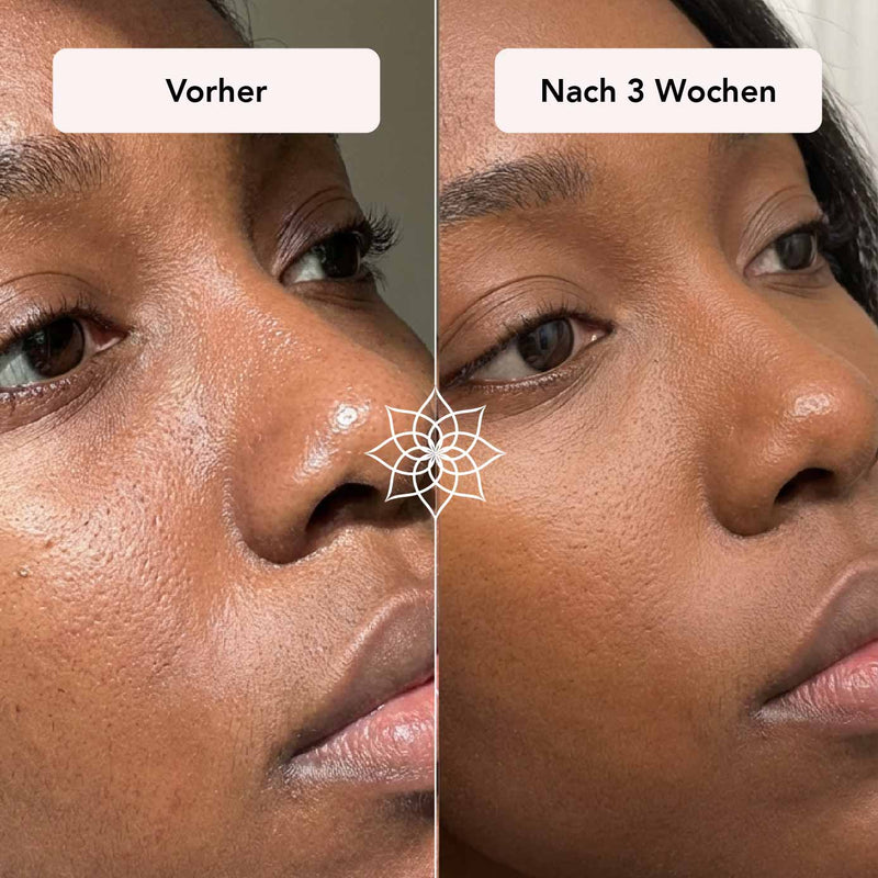 Vergrößerte Poren auf Wange und Nase