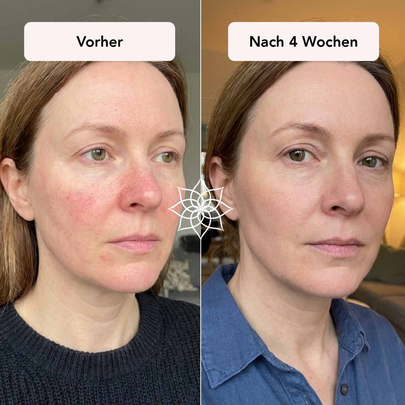 Diffuse Rötungen im Gesicht