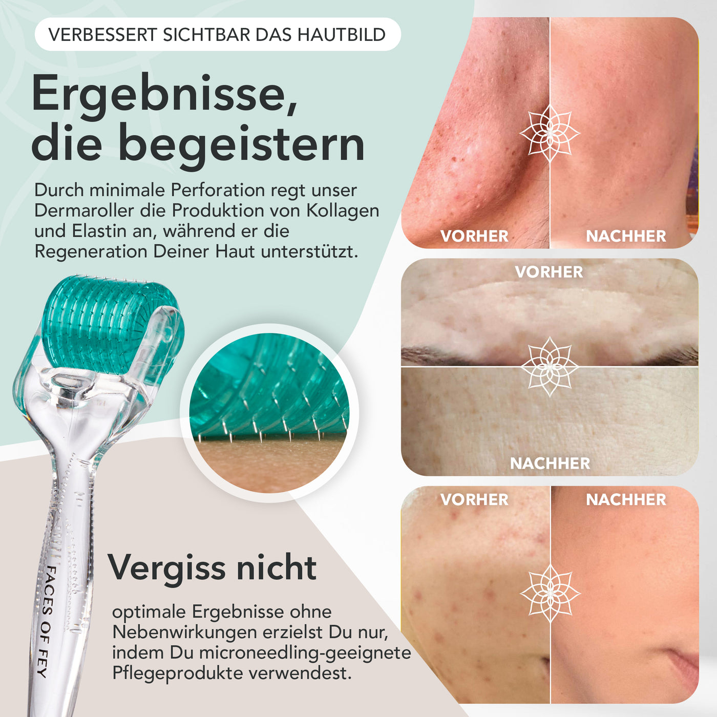 Dermaroller 0,50 mit ECHTEN Nadeln vom Needling-Experten FACES OF FEY