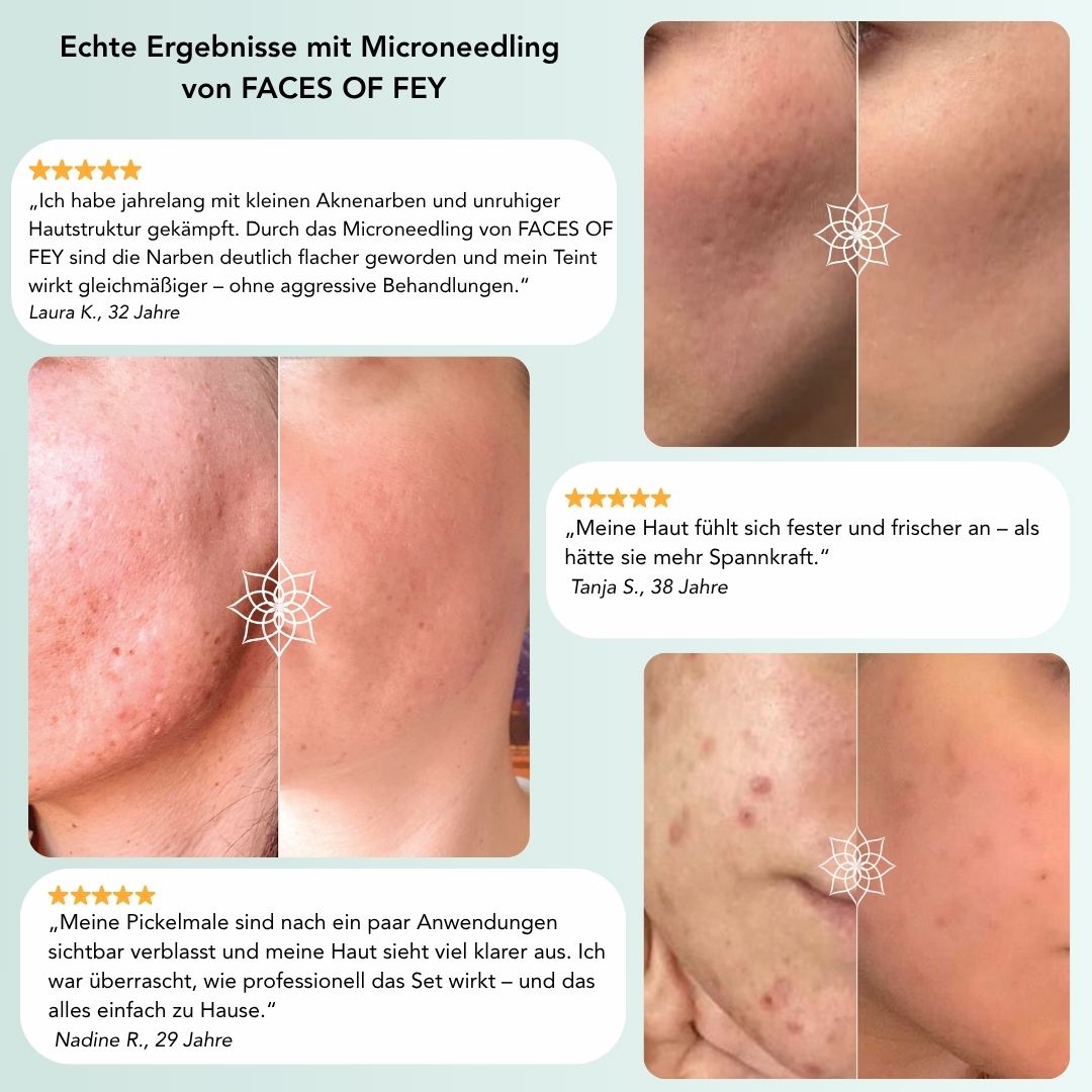 Glow & Discover - Microneedling Essentials